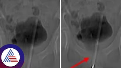 ಅಬ್ಬಬ್ಬಾ..ಬಾಲಕನ ಶಿಶ್ನದಲ್ಲಿ ಸಿಲುಕಿಕೊಂಡಿತ್ತು ಅಷ್ಟುದ್ದದ ಥರ್ಮೋಮೀಟರ್‌ !