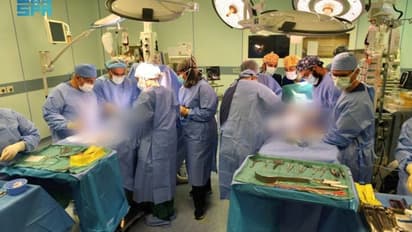 ആറ് ഘട്ടങ്ങളിലായി 11 മണിക്കൂര്‍ ശസ്ത്രക്രിയ; ഇറാഖി സയാമീസ് ഇരട്ടകളെ വിജയകരമായി വേർപെടുത്തി