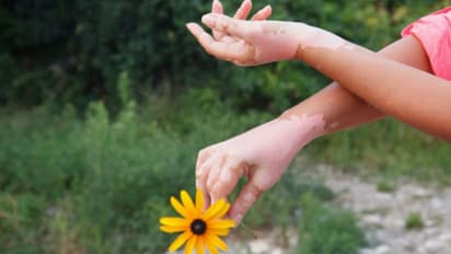 ശ്രദ്ധിക്കാതെ പോകരുത് വെള്ളപ്പാണ്ടിന്റെ ഈ ആദ്യ ലക്ഷണങ്ങൾ...