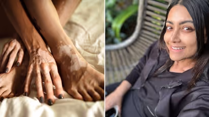 What Is Vitiligo? Mamta Mohandas experiences skin color loss; know the symptoms, causes and more