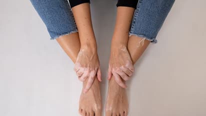 Health Tips: బొల్లి, తెల్ల మచ్చలతో ఇబ్బంది పడుతున్నారా.. ఆయుర్వేదంతో అదుపులో పెట్టండిలా?