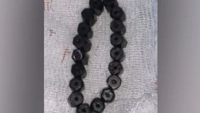 കഠിനമായ വയറുവേദന; നാല് വയസുകാരന്റെ വയറില് നിന്ന് നീക്കം ചെയ്തത് മാഗ്നറ്റിക് ബ്രേസ്ലെറ്റ്