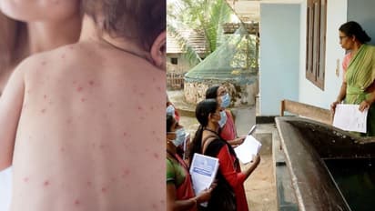 അഞ്ചാം പനി വ്യാപകമായിട്ടും വാക്‌സിൻ  എടുക്കാൻ മടി, നാദാപുരത്ത് മഹല്ല് കമ്മിറ്റികളുടെ സഹായം തേടി പഞ്ചായത്ത്