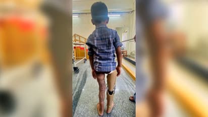 അപകടത്തില്‍ കാല് നഷ്ടമായി; അഞ്ചു വയസുകാരന് സൗജന്യമായി കൃത്രിമ കാല്‍ നല്‍കി തൃശൂര്‍ മെഡിക്കല്‍ കോളേജ്