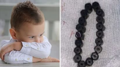 4 வயது சிறுவன் வயிற்றில் ப்ரேஸ்லெட்.. அதிர்ச்சி அடைந்த மருத்துவர்கள் !