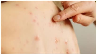 Pakistan: 17 children die from Measles in Sindh over two months amid rising cases