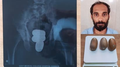 കണ്ണൂരിൽ മലദ്വാരത്തിൽ ഒളിപ്പിച്ച് സ്വർണ്ണക്കടത്ത്: പരിയാരത്തെ ഡോക്ടർമാരുടെ സഹായത്തിൽ പുറത്തെടുത്ത് പൊാലീസ്