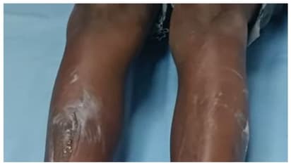 അടുത്ത വീട്ടില് നിന്നും ടയറെടുത്ത് കത്തിച്ചു, ചട്ടുകം പഴുപ്പിച്ച് ഏഴ് വയസുകാരനെ പൊള്ളിച്ച് അമ്മ