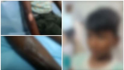 ഇടുക്കിയില് ഏഴ് വയസുകാരനെ ചട്ടുകം പഴുപ്പിച്ച് പൊള്ളിച്ച സംഭവം; അമ്മ അറസ്റ്റിൽ