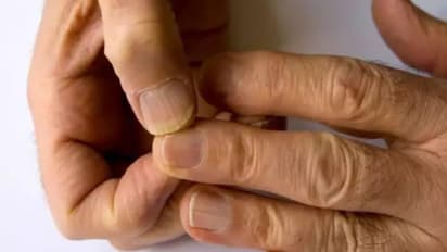 തൊലിപ്പുറത്ത് വരുന്ന തടിപ്പ് മുതല്‍ നിറം മങ്ങിയ നഖങ്ങള്‍ വരെ; അറിയാം കൊളസ്‌ട്രോളിന്‍റെ ലക്ഷണങ്ങള്‍...  