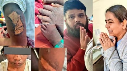  ಸುಶಿಕ್ಷಿತ ದಂಪತಿಯ ಅನಾಗರಿಕ ವರ್ತನೆ: 17 ವರ್ಷದ ಮನೆಕೆಲಸದಾಕೆಗೆ ಚಿಮ್ಟದಲ್ಲಿ ಸುಟ್ಟು ಚಿತ್ರಹಿಂಸೆ