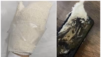 കൈയിലിരുന്ന മൊബൈല് ഫോൺ പൊട്ടിത്തെറിച്ച് 13 വയസുകാരിക്ക് പൊള്ളലേറ്റു