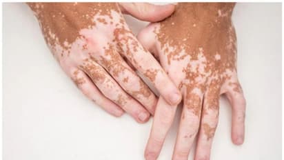 Vitiligo: బొల్లి వ్యాధికి కారణాలు ఇవే.. నిర్లక్ష్యం చేస్తే సమస్యలు తప్పవు?