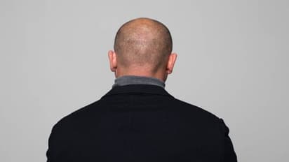 തല മൊട്ടയായതിനാൽ രാജി വെപ്പിച്ചു, 70 ലക്ഷം നഷ്ടപരിഹാരം!