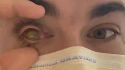 ഇരുപത്തിയൊന്നുകാരന്റെ കാഴ്ച നഷ്ടപ്പെട്ടു; കാരണമായ സംഭവം ഏവരും ശ്രദ്ധിക്കേണ്ടത്...