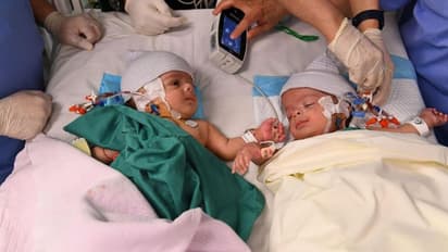 എട്ട് മണിക്കൂര്‍ നീണ്ട ശസ്‍ത്രക്രിയ വിജയം; സല്‍മാനും അബ്‍ദുല്ലയ്ക്കും ഇനി രണ്ട് കിടക്കകളില്‍ ഉറങ്ങാം