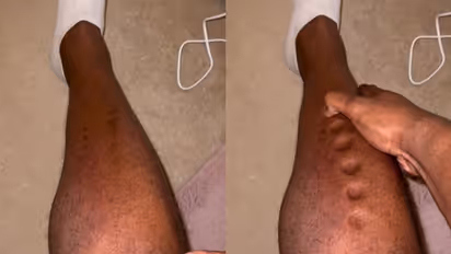 'കളിമണ്ണ് പോലെ...'; അപൂര്വ രോഗം കാണിക്കുന്ന വീഡിയോയുമായി കായികതാരം...