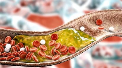 Is your cholesterol level high? Here are some effective ways to keep in check