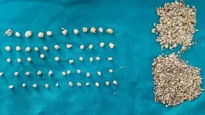 പ്രമേഹരോഗിയായ സ്ത്രീയുടെ പിത്താശയത്തില് നിന്ന് നീക്കം ചെയ്തത് 1200 കല്ല്!