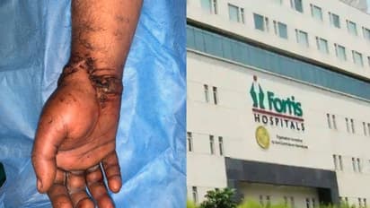 ಮೆಷಿನ್ಗೆ ಸಿಲುಕಿ ತುಂಡಾಗಿದ್ದ ಕೈ ಮಣಿಕಟ್ಟನ್ನು ಯಶಸ್ವಿಯಾಗಿ ಮರುಜೋಡಿಸಿದ ವೈದ್ಯರು