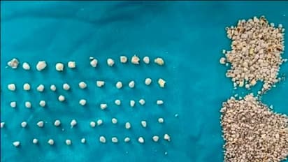 ಮಹಿಳೆ ಪಿತ್ತಕೋಶದಲ್ಲಿತ್ತು 2000 ಕ್ಕೂ ಹೆಚ್ಚು ಕಲ್ಲುಗಳು..!