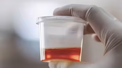 Urine color: ಮೂತ್ರದ ಬಣ್ಣ ನೋಡಿ, ಆರೋಗ್ಯ ಸಮಸ್ಯೆ ಬಗ್ಗೆ ತಿಳ್ಕೊಳ್ಳಿ