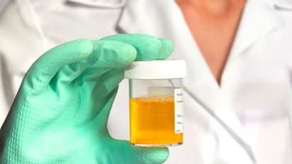 മൂത്രത്തിന്റെ നിറത്തിലുള്ള ഈ വ്യത്യാസങ്ങള് പ്രത്യേകം ശ്രദ്ധിക്കുക; ഇത് സൂചിപ്പിക്കുന്ന രോഗങ്ങള്...