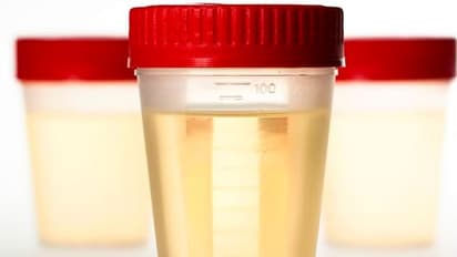 മൂത്രത്തിന്റെ ഗന്ധത്തില് ഈ വ്യത്യാസങ്ങള് വന്നാല് ശ്രദ്ധിക്കുക...