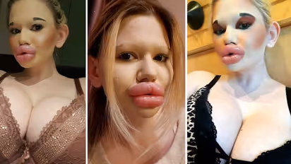 Bizarre: Woman who spent Rs 8 lakh to have 'world's biggest lips' reveals latest beauty goal