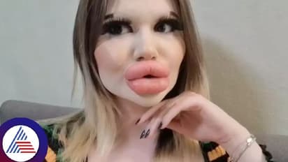 ವಿಶ್ವದ ಅತಿ ದೊಡ್ಡ ತುಟಿ ಹೊಂದಿರುವ ಮಹಿಳೆಯೀಕೆ, 34ಕ್ಕೂ ಹೆಚ್ಚು ಇಂಜೆಕ್ಷನ್ ಹಾಕಿಸಿಕೊಂಡಿದ್ದಾಳಂತೆ!