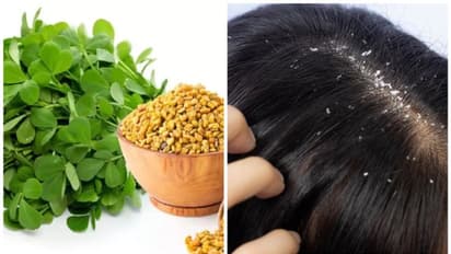 మెంతికూరతో చుండ్రు సమస్యకు చెక్.. ఇది మాత్రమే కాదు ఆ సమస్యలన్నీ మాయం!