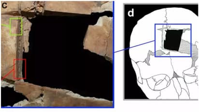 വെങ്കലയുഗത്തില്‍ മനുഷ്യന്‍ മസ്തിഷ്ക ശസ്ത്രക്രിയ ചെയ്തെന്ന് പുരാവസ്തു ഗവേഷകര്‍ !
