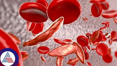 ಸಿಕಲ್‌ ಸೆಲ್‌ ಅನೀಮಿಯಾ ಪತ್ತೆಗೆ ಬೆಂಗಳೂರು ಸ್ಟಾರ್ಟಪ್‌ ಕಿಟ್‌