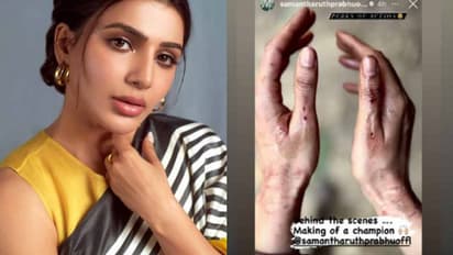 ഷൂട്ടിംഗിനിടയില് നടി സാമന്തയ്ക്ക് പരുക്കേറ്റു