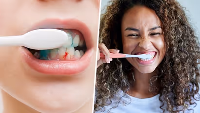 Three crucial oral hygiene habits to avoid bleeding gums and cavities