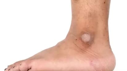 Health Tip : കാലില് നിറവ്യത്യാസവും പാടുകളും കാഴ്ചയ്ക്ക് മങ്ങലും; തിരിച്ചറിയാം ഈ പ്രശ്നത്തെ...