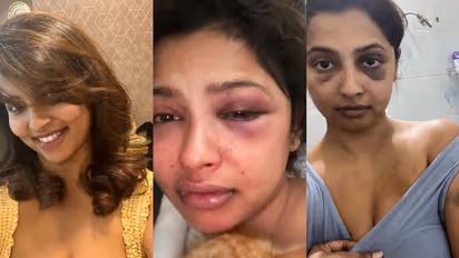 'മുൻ കാമുകൻ ക്രൂരമായി മര്ദ്ദിച്ചു', ഫോട്ടോകള് പുറത്തുവിട്ട് നടി