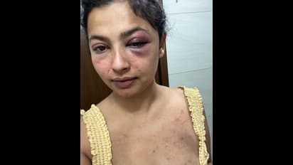 நடிகை அனிக்காவை கொடூரமாக தாக்கிய முன்னாள் காதலர்.. வீங்கிய முகத்துடன் நடிகை வெளியிட்ட அதிர்ச்சி புகைப்படங்கள்!