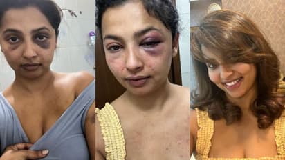 ಮಾಜಿ ಪ್ರಿಯತಮನಿಂದ ಚಿತ್ರಹಿಂಸೆ, ಹಲ್ಲೆ; ಫೋಟೋ ಶೇರ್ ಮಾಡಿ ಭಯಾನಕ ಘಟನೆ ಬಿಚ್ಚಟ್ಟ ನಟಿ ಅನಿಕಾ