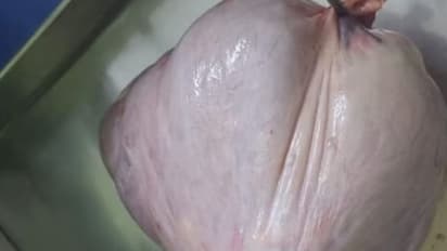 ಮಹಿಳೆಯ ಹೊಟ್ಟೆಯಲ್ಲಿತ್ತು 8 ಕೆಜಿ ಗಡ್ಡೆ: ವೈದ್ಯರಿಂದ ಯಶಸ್ವಿ ಶಸ್ತ್ರಚಿಕಿತ್ಸೆ 