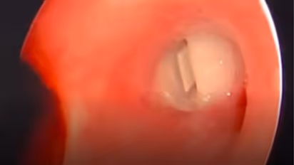 നാല് വയസുകാരന്റെ തൊണ്ടയില് കുടുങ്ങിയ 'വിസില്' വിജയകരമായി പുറത്തെടുത്തു