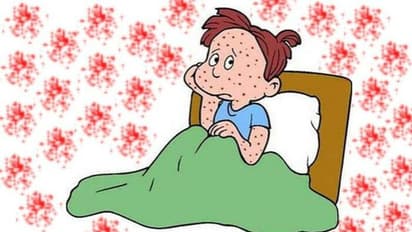 വേനലിനൊപ്പം പടര്ന്ന് ചിക്കൻപോക്സ്; ശ്രദ്ധിക്കേണ്ട കാര്യങ്ങൾ...