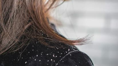 തലമുടി കൊഴിച്ചിലും താരനും കുറയ്ക്കാൻ പരീക്ഷിക്കാം ഈ നാല് ഹെയർ പാക്കുകൾ...