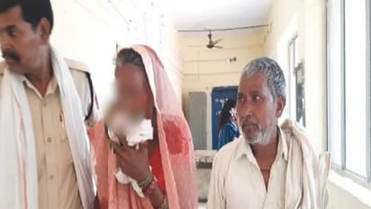  ಪತ್ನಿ ತೊರೆದು ಹೋದ ಸಿಟ್ಟು :  ಅತ್ತೆಯ ಮೂಗು ಕಚ್ಚಿ ತುಂಡರಿಸಿದ  ಅಳಿಯ!