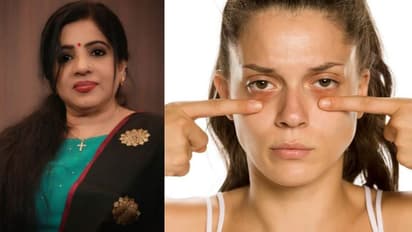കണ്ണിന് ചുറ്റുമുള്ള 'ഡാർക്ക് സർക്കിൾസ്' മാറ്റാൻ ടിപ്സ് പങ്കുവച്ച് അനില ജോസഫ്...