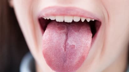 നാവില് വെളുത്ത പാടുകള്, വായിലോ കഴുത്തിലോ ചെറിയ വീക്കം; തിരിച്ചറിയൂ ഈ ലക്ഷണങ്ങളെ...