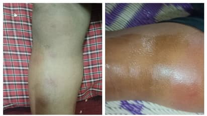 ഹൃദ്രോഗിയായ കുട്ടിയെ അടിച്ചു, നുള്ളി, കരച്ചിൽ ജലദോഷം കൊണ്ടെന്ന് മറുപടി; അങ്കണവാടി ആയക്കെതിരെ പരാതി