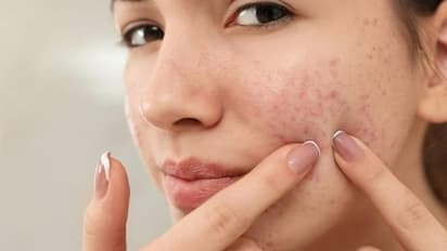 മുഖക്കുരു ഉണ്ടാകുമ്പോള് ഇക്കാര്യങ്ങള് ചെയ്യാറുണ്ടോ? എങ്കില് ശ്രദ്ധിക്കുക....