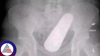 ಗುದನಾಳದಲ್ಲಿ ಸಿಲುಕಿತ್ತು ಸೌತೆಕಾಯಿ, ಬೀಜ ತಿಂದಿದ್ದೆ ಎಂದ ವ್ಯಕ್ತಿ, ದಂಗಾದ ವೈದ್ಯರು!