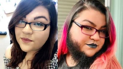 ഒമ്പതാം വയസ് മുതൽ ഷേവ് ചെയ്യേണ്ടി വന്നു, ഇപ്പോൾ താടിരോമം വളർത്തി യുവതി, ഇങ്ങനെ നീ സുന്ദരിയാണ് എന്ന് കാമുകനും